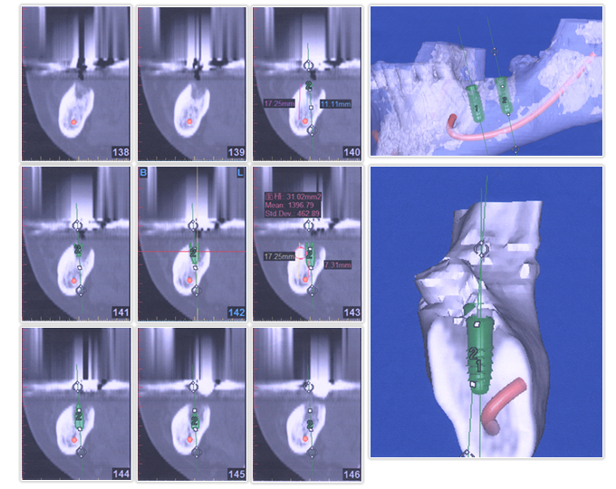 CT画像とインプラントシュミレーション