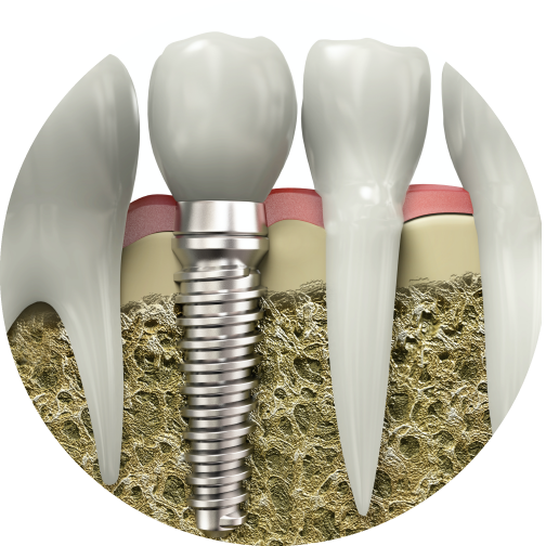 インプラントってどんなもの？