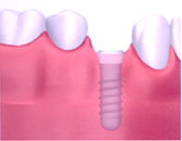 インプラント埋入