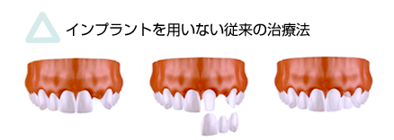 インプラントを用いない従来の治療法