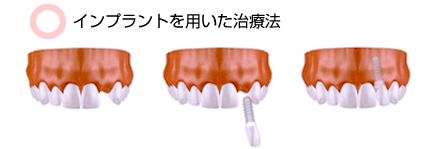 インプラントを用いた治療法