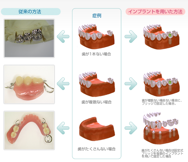 インプラントと従来の治療法の比較
